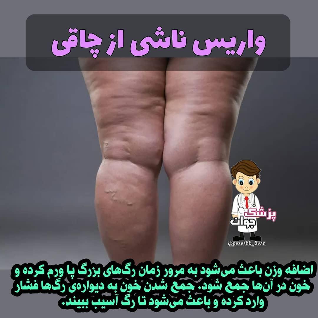 جوراب واریس